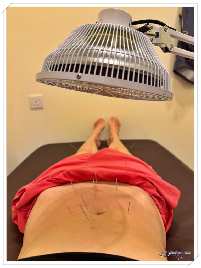 TCM Acupuncture Treatment with Heat