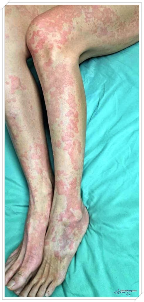Wifey’s hives flare up badly especially at night.